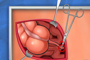 艾梅医生阑尾炎手术小游戏